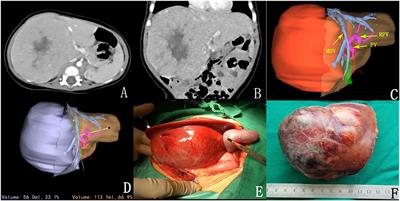 Clinical and Pathological Study of Tumor Border Invasion—Is Narrow Resection Margin Acceptable in Hepatoblastoma Surgery?